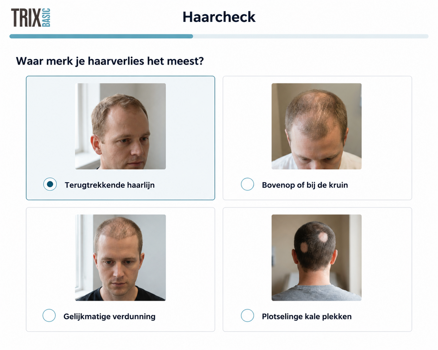 TRIX Hair Check met vier mogelijke patronen van haarverlies bij mannen.